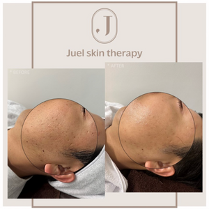 juel-skin-therapy-product-thumbnail-2